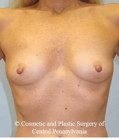 Breast Reconstruction Before