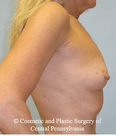 Breast Reconstruction Before
