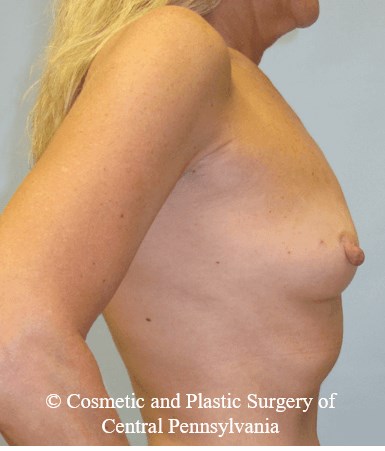 Breast Reconstruction Before