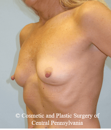 Breast Reconstruction Before