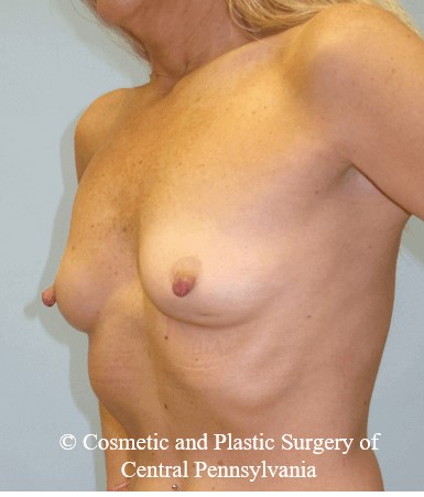 Breast Reconstruction Before