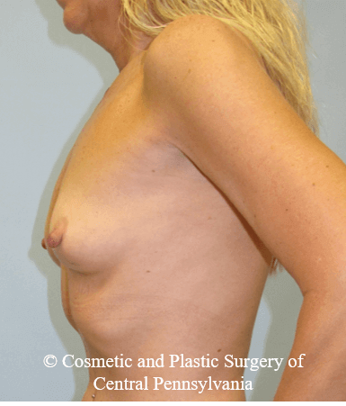 Breast Reconstruction Before