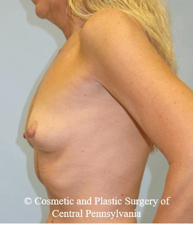 Breast Reconstruction Before
