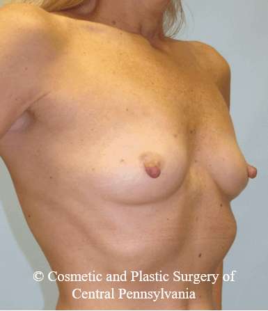Breast Reconstruction Before