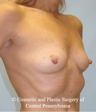 Breast Reconstruction Before