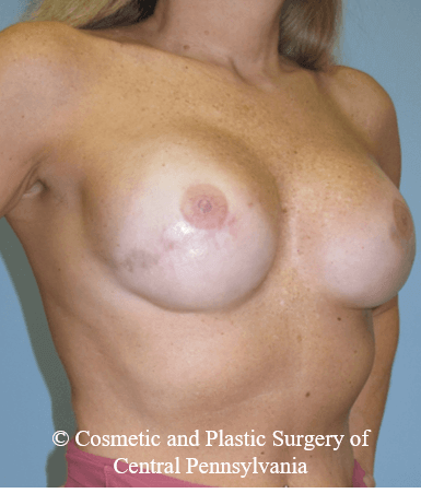 Breast Reconstruction After