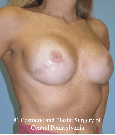 Breast Reconstruction After