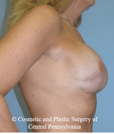 Breast Reconstruction After