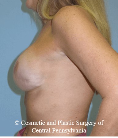 Breast Reconstruction After