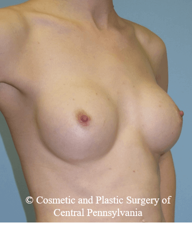 Breast Reconstruction Before