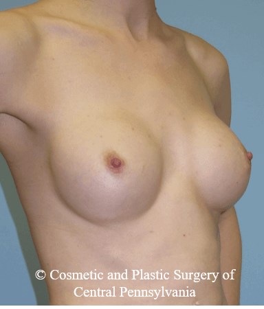 Breast Reconstruction Before