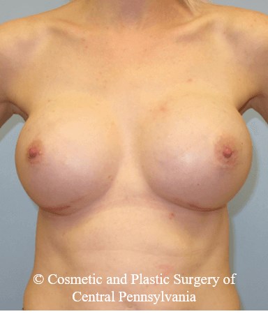 Breast Reconstruction After