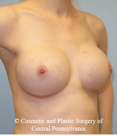 Breast Reconstruction After