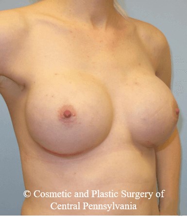 Breast Reconstruction After