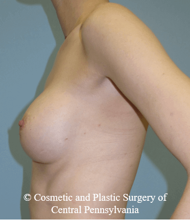 Breast Reconstruction Before