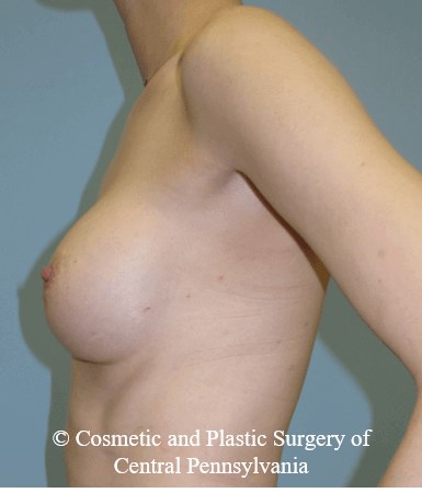 Breast Reconstruction Before