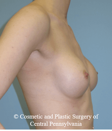 Breast Reconstruction Before