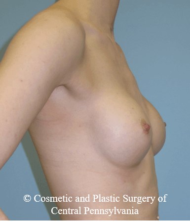 Breast Reconstruction Before