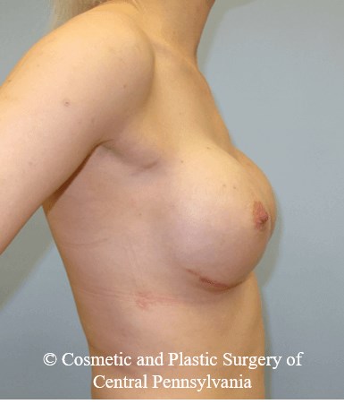 Breast Reconstruction After