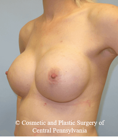 Breast Reconstruction After