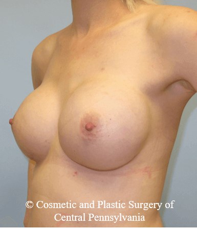 Breast Reconstruction After