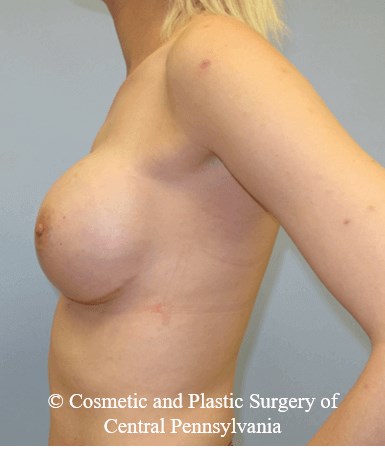 Breast Reconstruction After