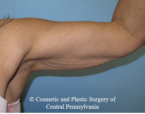 Arm Lift Before