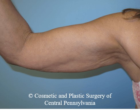Arm Lift Before