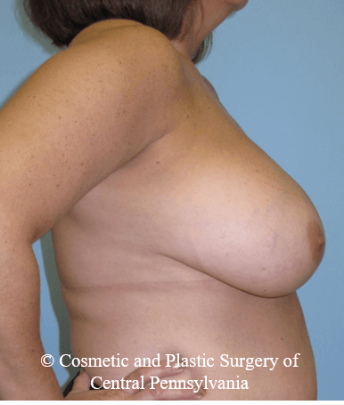 Breast Reduction Before