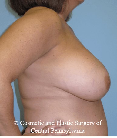 Breast Reduction Before