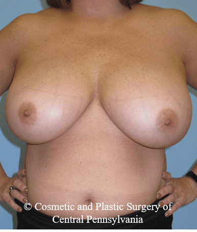 Breast Reduction Before