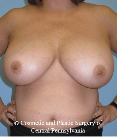 Breast Reduction Before