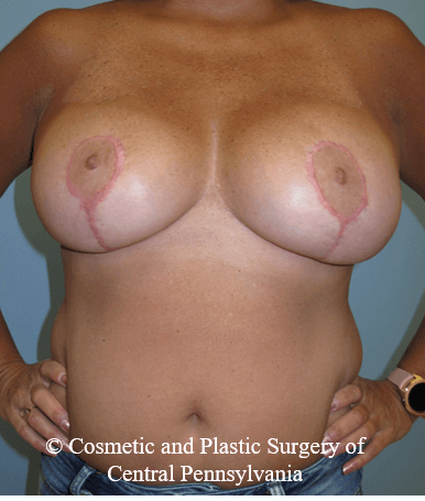 Breast Reduction After