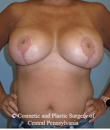 Breast Reduction After