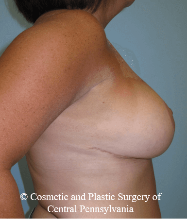 Breast Reduction After