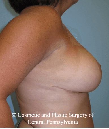 Breast Reduction After