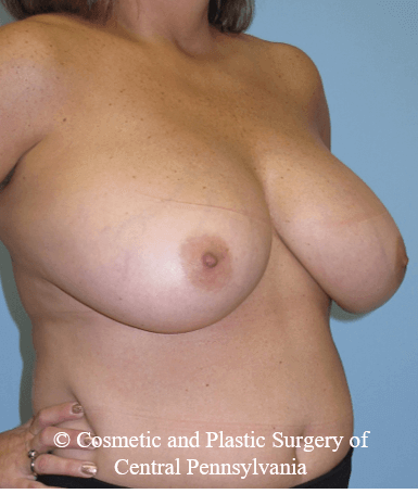 Breast Reduction Before