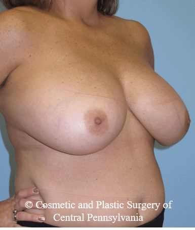 Breast Reduction Before