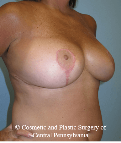Breast Reduction After