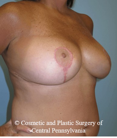 Breast Reduction After