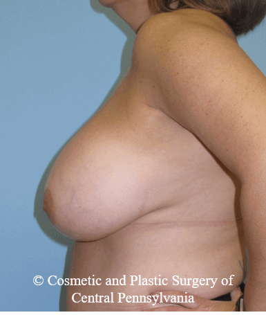 Breast Reduction Before