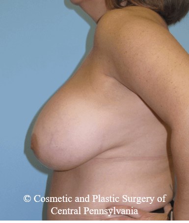 Breast Reduction Before