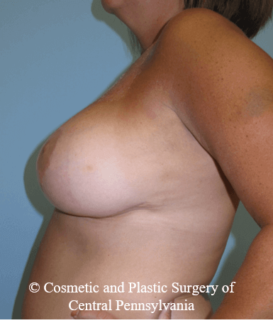 Breast Reduction After