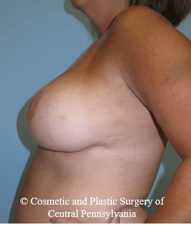 Breast Reduction After