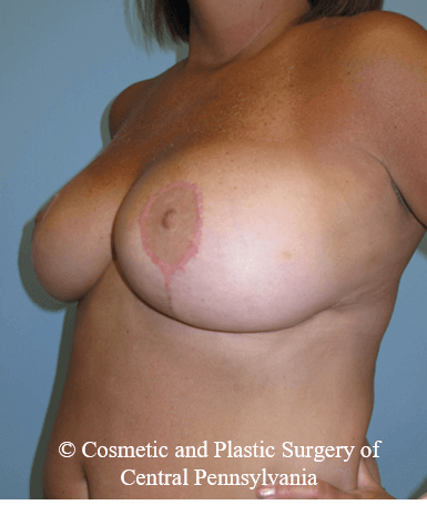 Breast Reduction After