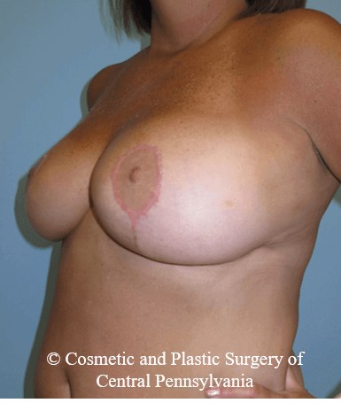 Breast Reduction After