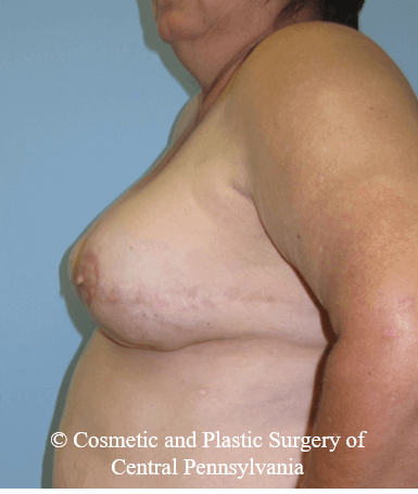 Breast Reconstruction After