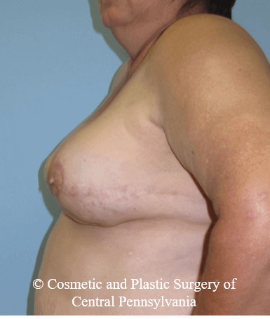 Breast Reconstruction After