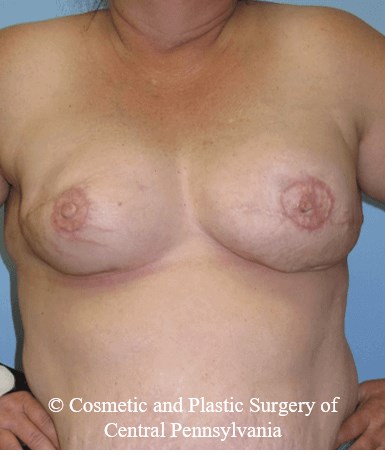 Breast Reconstruction After