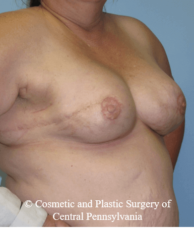 Breast Reconstruction After